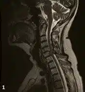 Spinal Cord Compression Treatment Houston TX