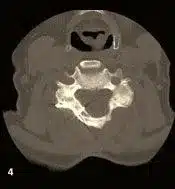Cervical Laminoplasty Sugarland TX
