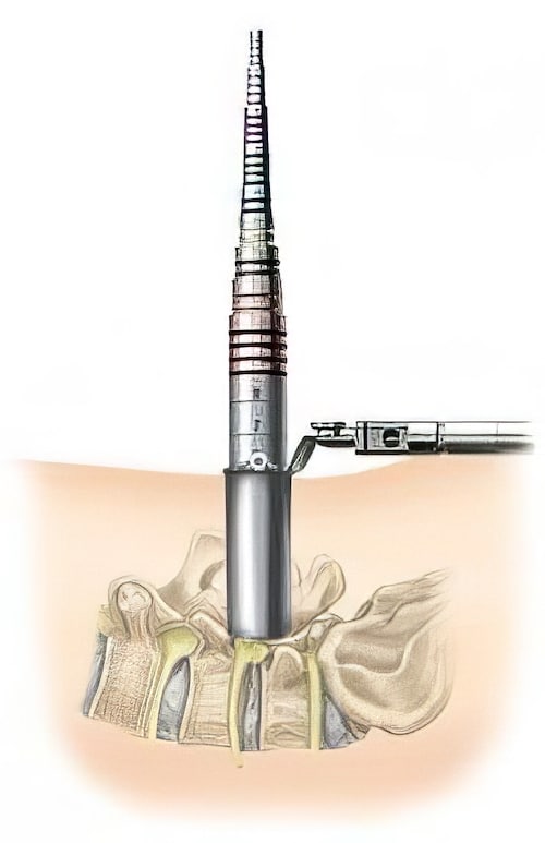 Minimally Invasive Spine Surgery Sugarland TX