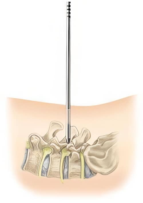 Minimally Invasive Spine Surgery Houston TX